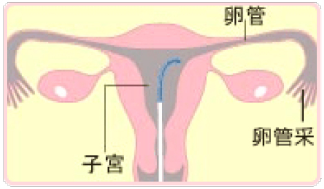 卵管鏡下卵管形成術